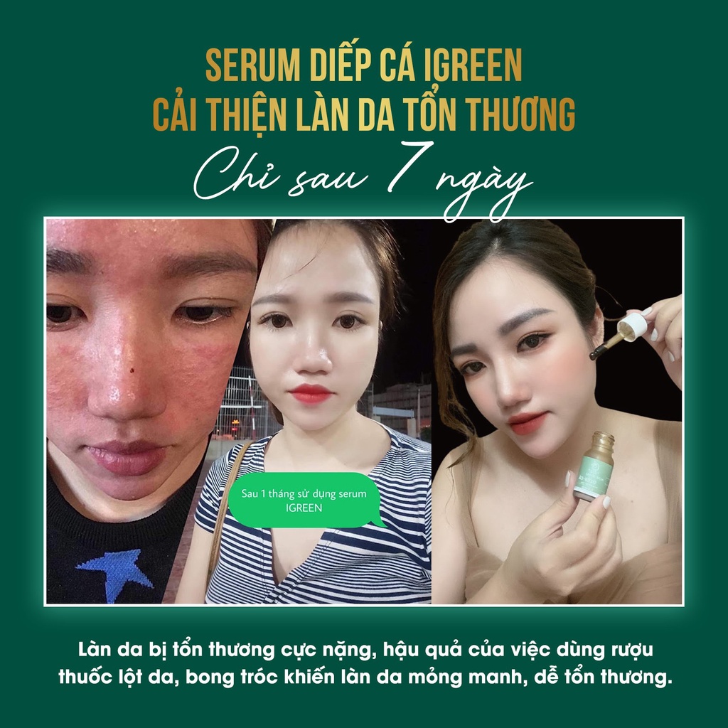 SERUM SẠCH MỤN HOÀN TOÀN - SERUM DIẾP CÁ IGREEN - BAY MỤN, THÂM, RỖ