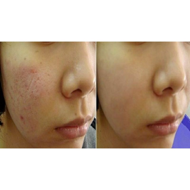 Serum Sẹo Rỗ.Sẹo Mụn Macoizy