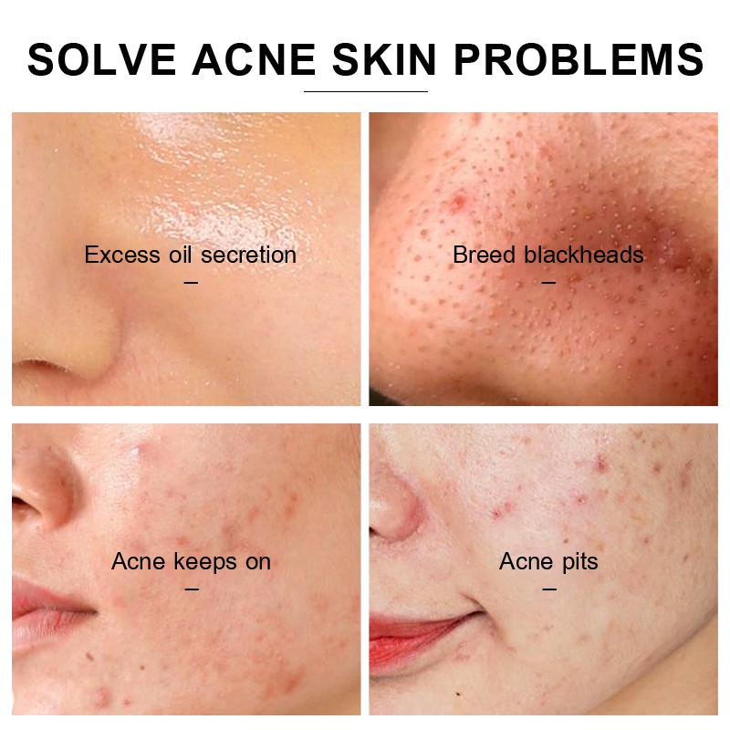 Set 3 sản phẩm VIBRANT GLAMOUR chiết xuất tràm trà cải thiện sẹo/mụn trứng cá chăm sóc da | BigBuy360 - bigbuy360.vn