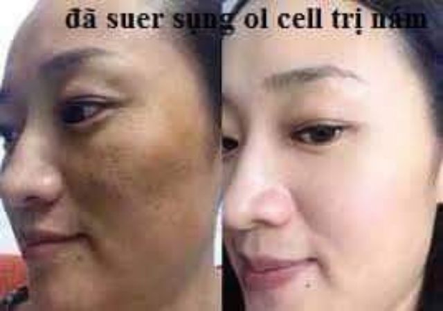 Hút nám thải độc da