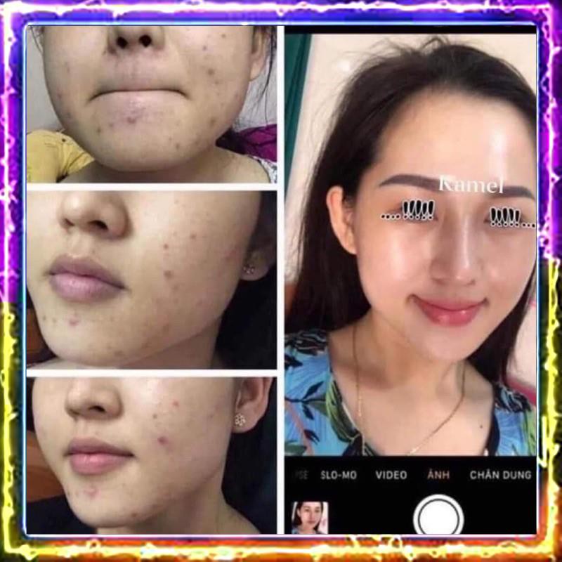 [Sẵn hàng] Detox Acnes Serum - Serum loại bỏ mụn Kamel 10ml | BigBuy360 - bigbuy360.vn