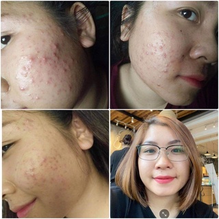Serum thanh dược Lare (80ml)