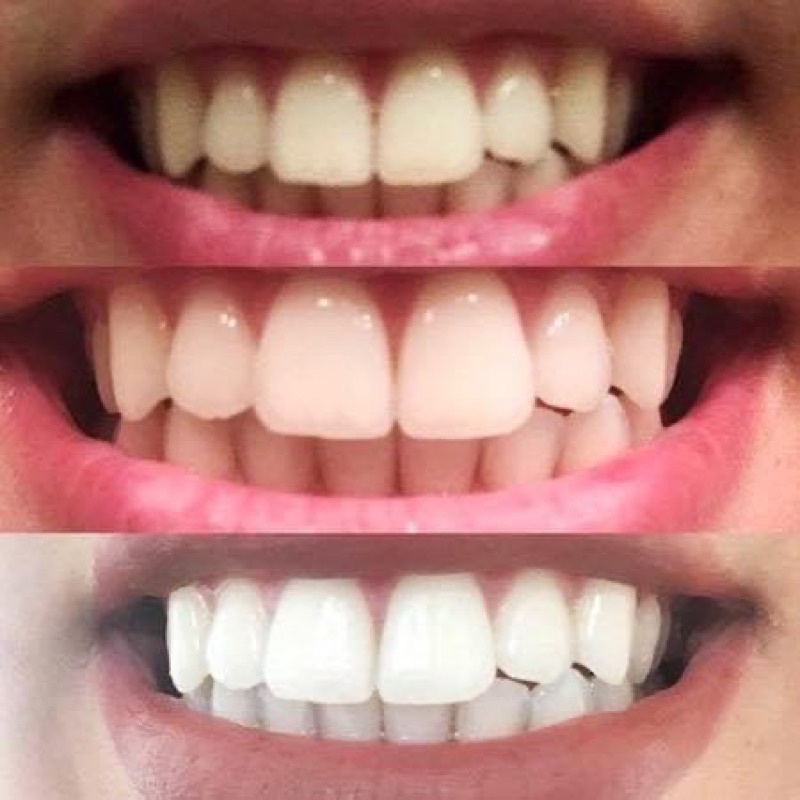 Date 2025  Set Tẩy Trắng Răng 60miếng Crest của Mỹ