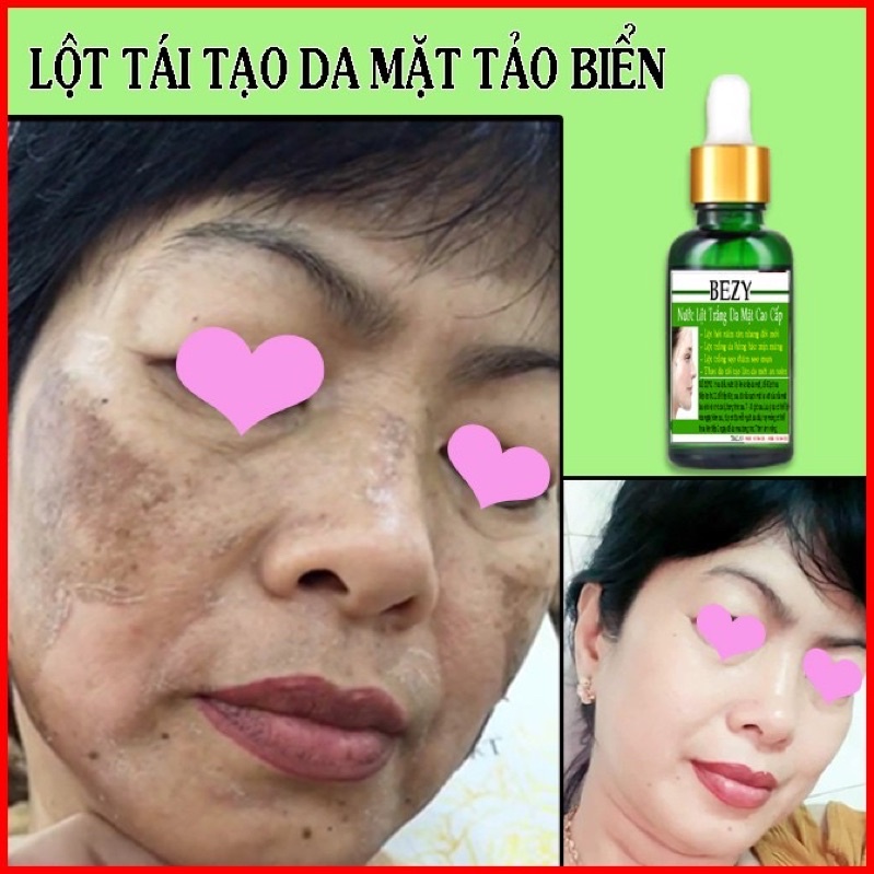 Tái Tạo Lột Thay Da Trắng Hết Nám Bezy