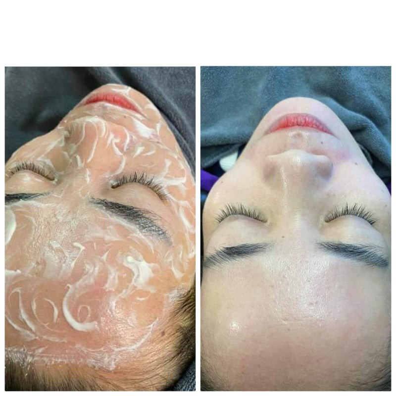 Nạ tổ yến- cấy trắng yến