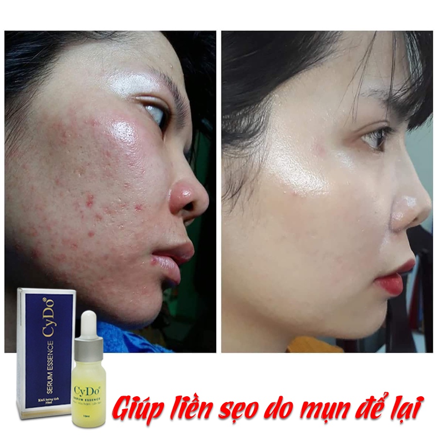 Serum mụn - xóa thâm - liền sẹo Cydo chính hãng