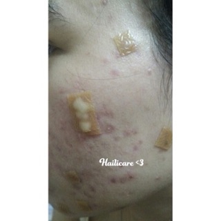 Miếng Dán Nhanh Xẹp Mụn DuoDerm Extra Thin (date 2026)