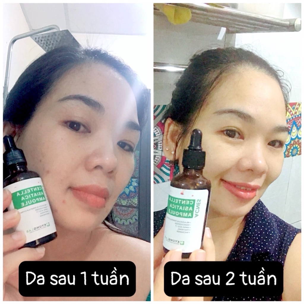 Tinh Chất Serum Giả.m Mụn, Ng.ừa Mụn Kyung Lab Acnes Centella Asiatica Ampoule 50ml