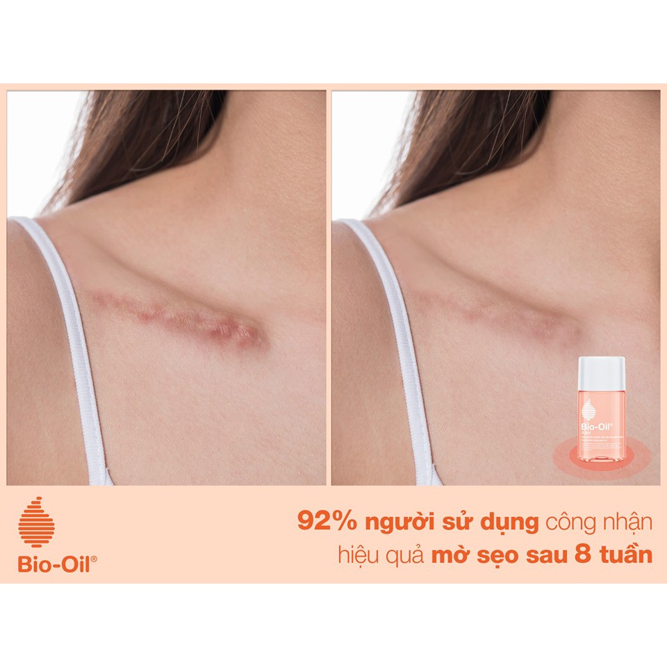 Tinh Dầu Rạn Da Mờ Sẹo Bio-Oil Scar Treatment