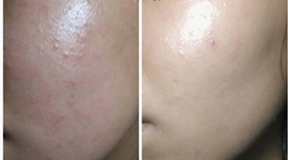 Sữa rửa mặt trị mụn Acne.org