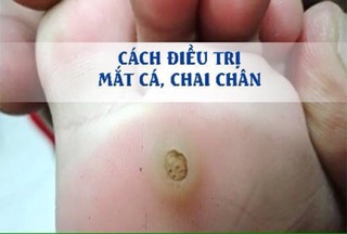 Miếng dán mụn cóc hộp 6 miếng