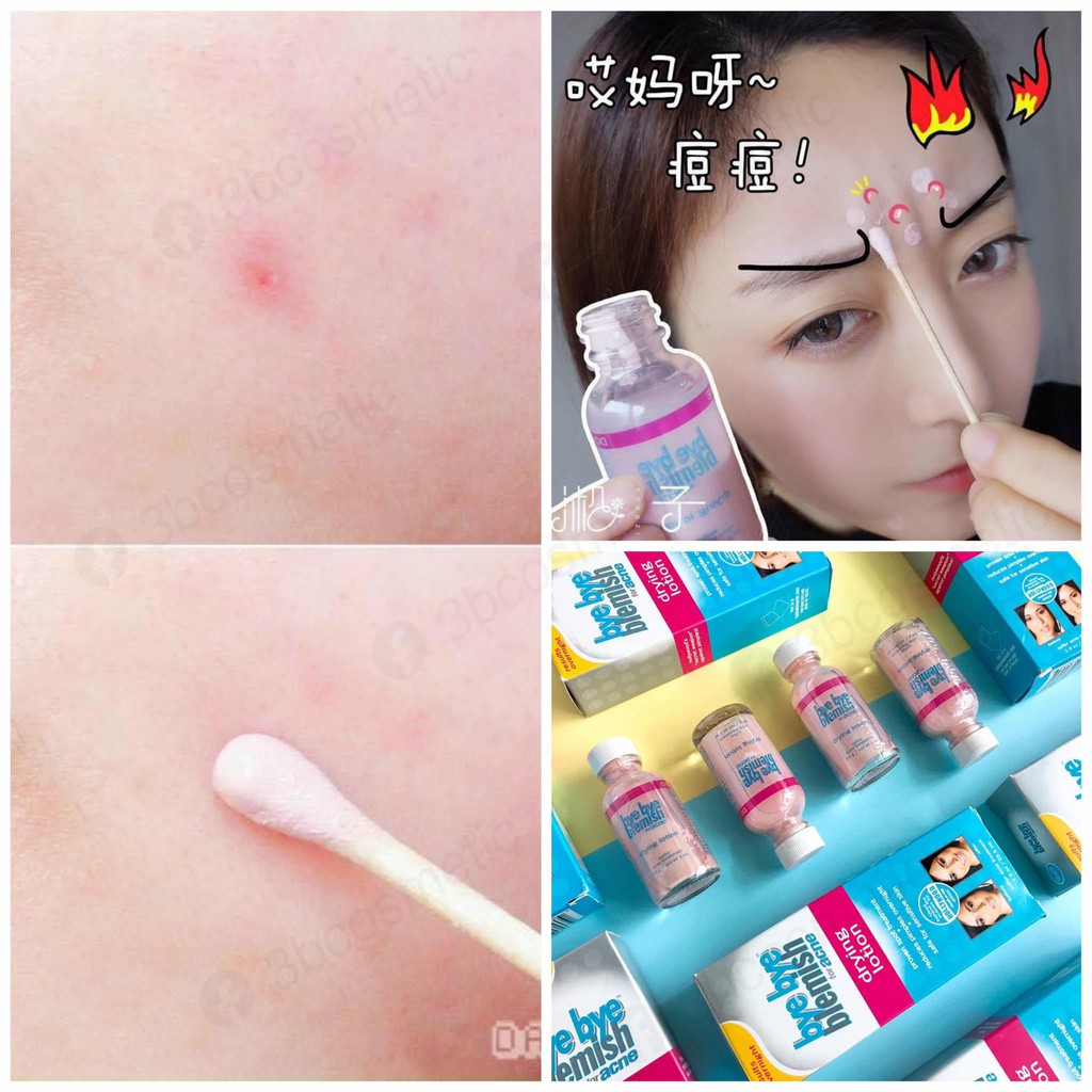 Chấm Mụn Bye Bye Blemish Drying Lotion