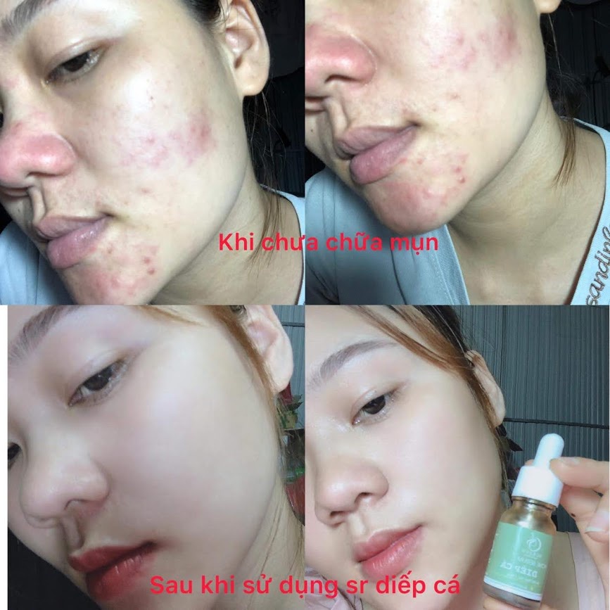 Serum Diếp Cá GIẢM MỤN, THÂM, SE KHÍT LỖ CHÂN LÔNG IGREEN - Acne Serum Diếp Cá IGREEN