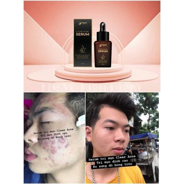 Tinh chất serum hết mụn_Hết thâm sạm do sẹo_Se khít lỗ chân lông