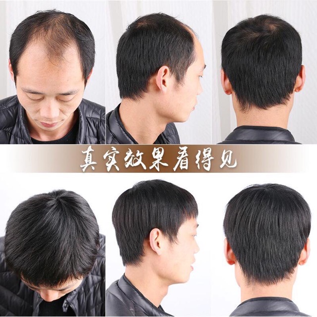 Tóc mái hói cho nam và nữ rụng tóc- hình thật