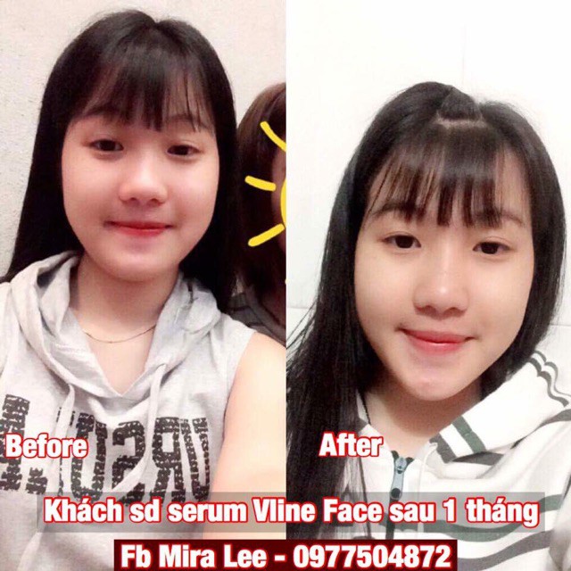 Tinh Chất Thon Gọn Mặt V- Line Miracle