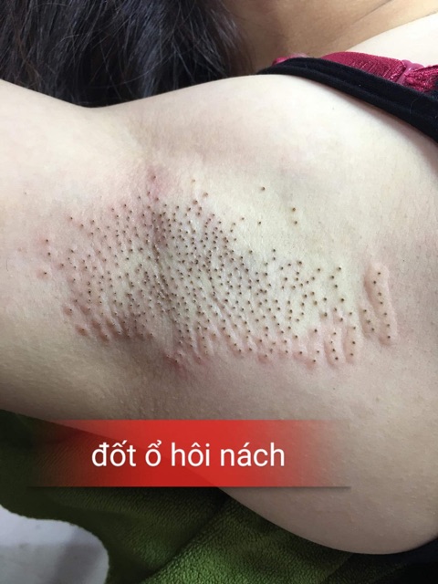 1 gói đốt ổ hôi nách dành cho spa, thẩm mỹ viện