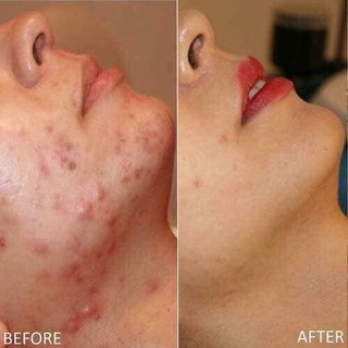 Kem trị mụn Retin-a