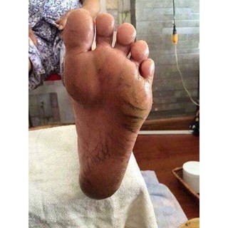 KEM TRI NỨT GÓT CHÂN NGA
