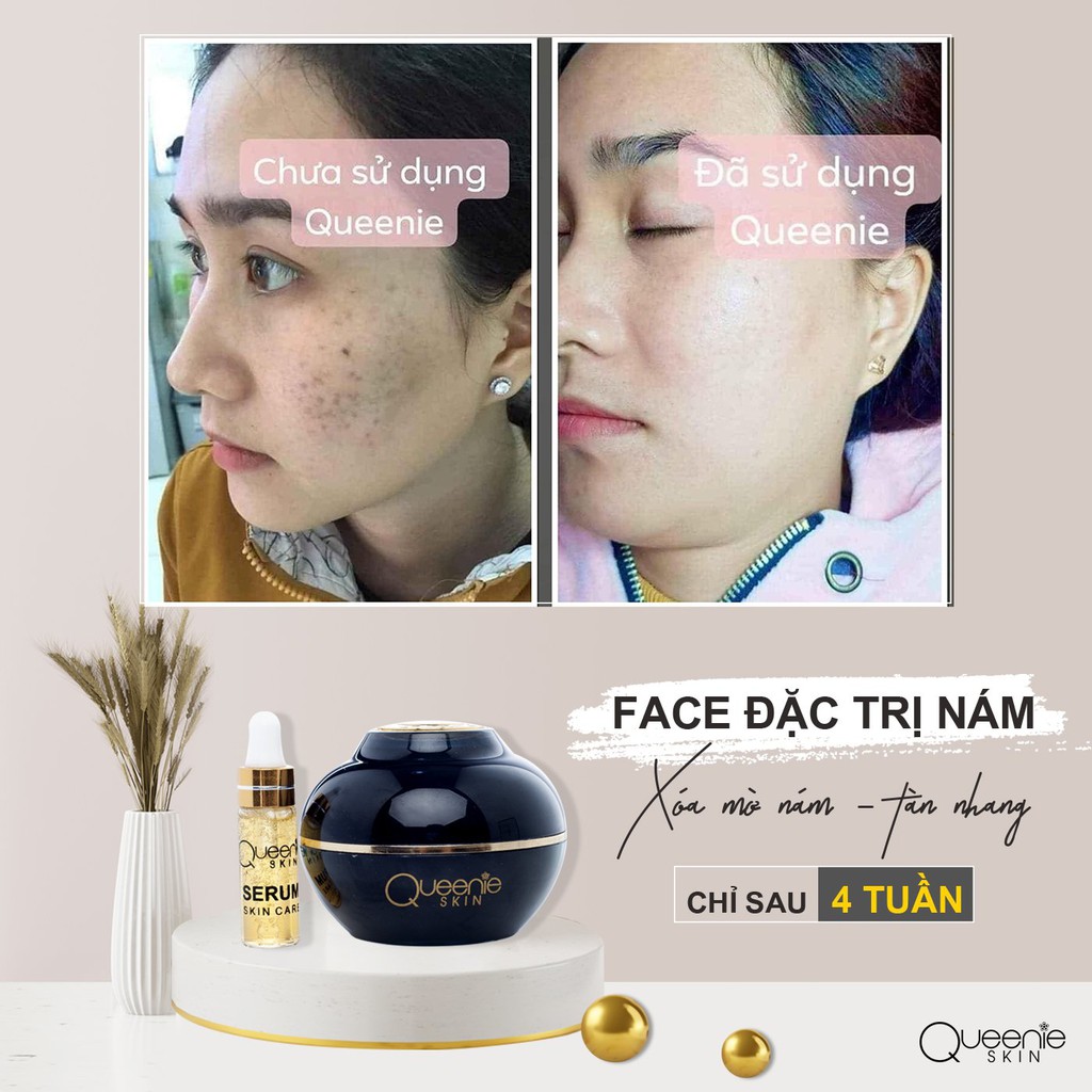 COMBO 2 Hộp Kem Nám, Tàn Nhang QUEENIE SKIN 30 Gram - HÀNG CHÍNH HÃNG