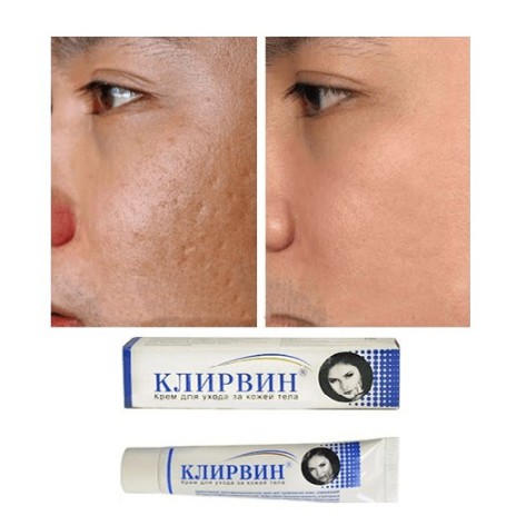 Kem Hỗ Trợ giảm Sẹo Klirvin Chính Hãng Của Nga | BigBuy360 - bigbuy360.vn