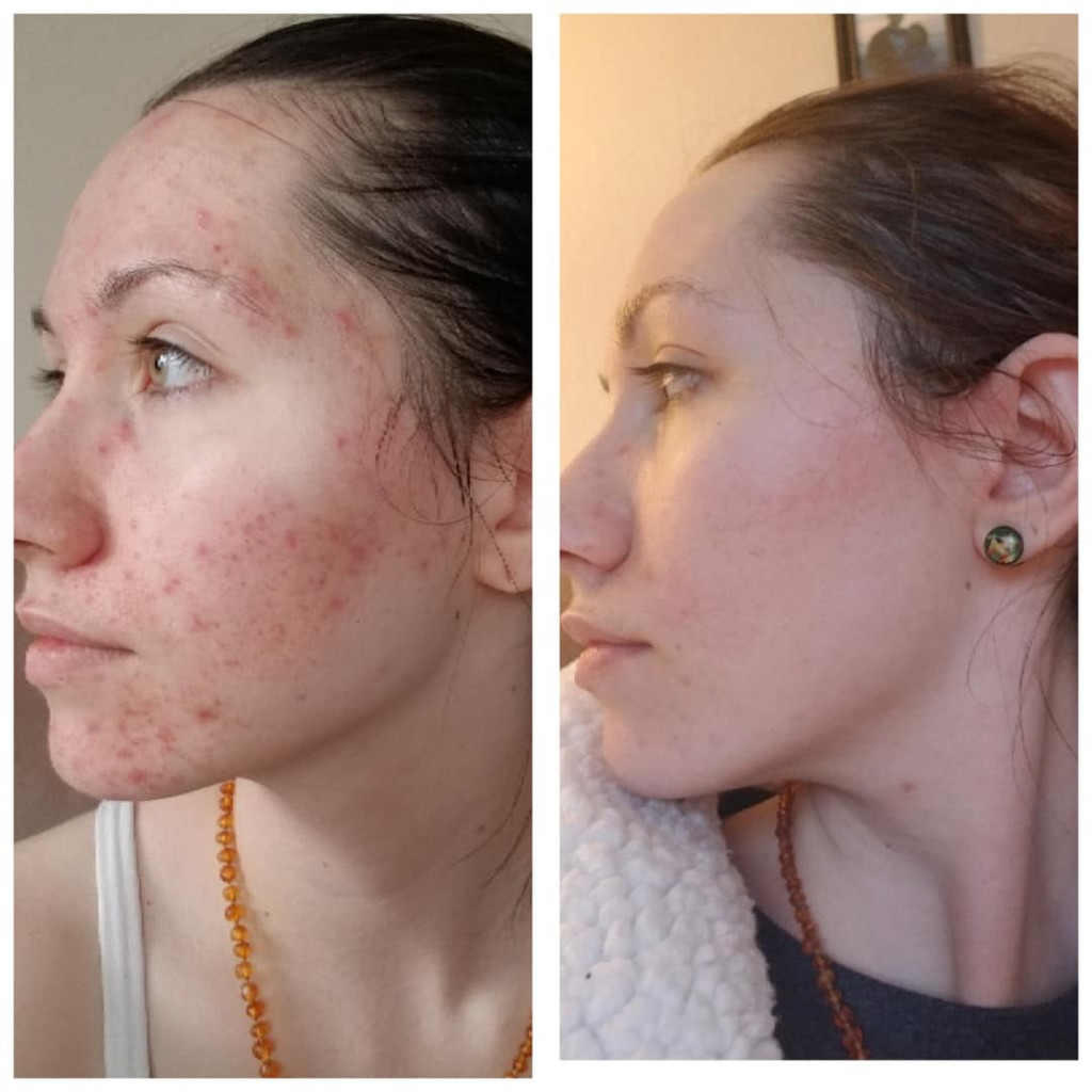 Toner tẩy da chết The Ordinary | BigBuy360 - bigbuy360.vn