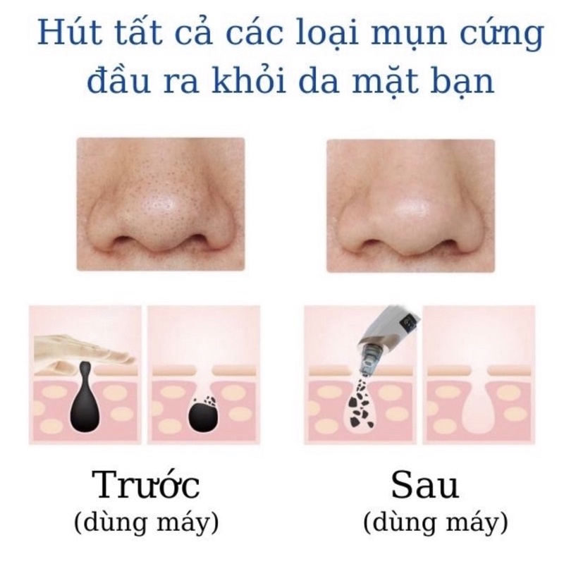 [Freeship] Máy Hút Mụn, Máy Hút Mụn Đầu Đen, Cám Bọc Cầm Tay Mini Sạc Pin Cao Cấp Blackhead 3 chế độ 6 đầu hút