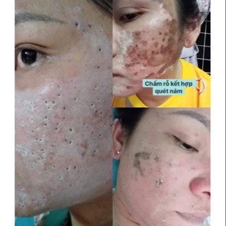 MỸ PHẨM PEEL TCA CHẤM NÁM, RO, TÀN NHANG, ĐỒI MOI..