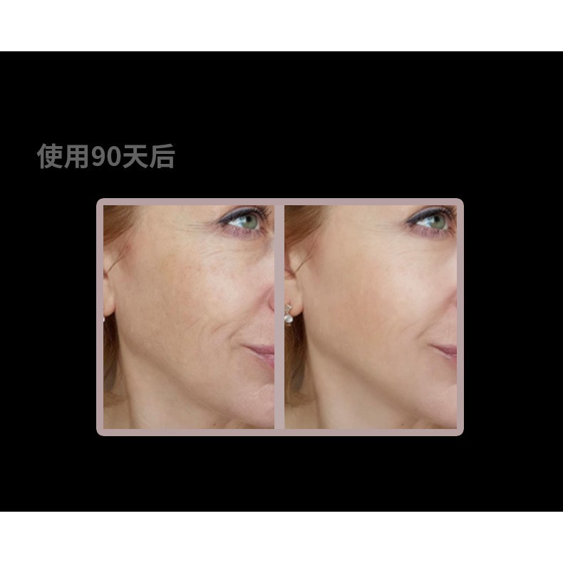 Máy xóa nọng cằm định hình khuôn mặt Vline V-Four thế hệ mới