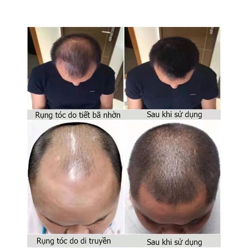 Xịt kích mọc tóc tinh dầu mọc tóc dưỡng tóc và ngăn ngừa rụng tóccó hiệu quả nhanh