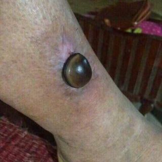 Hạt đậu lào ( hạt trị chó dại cắn) 10k/hạt
