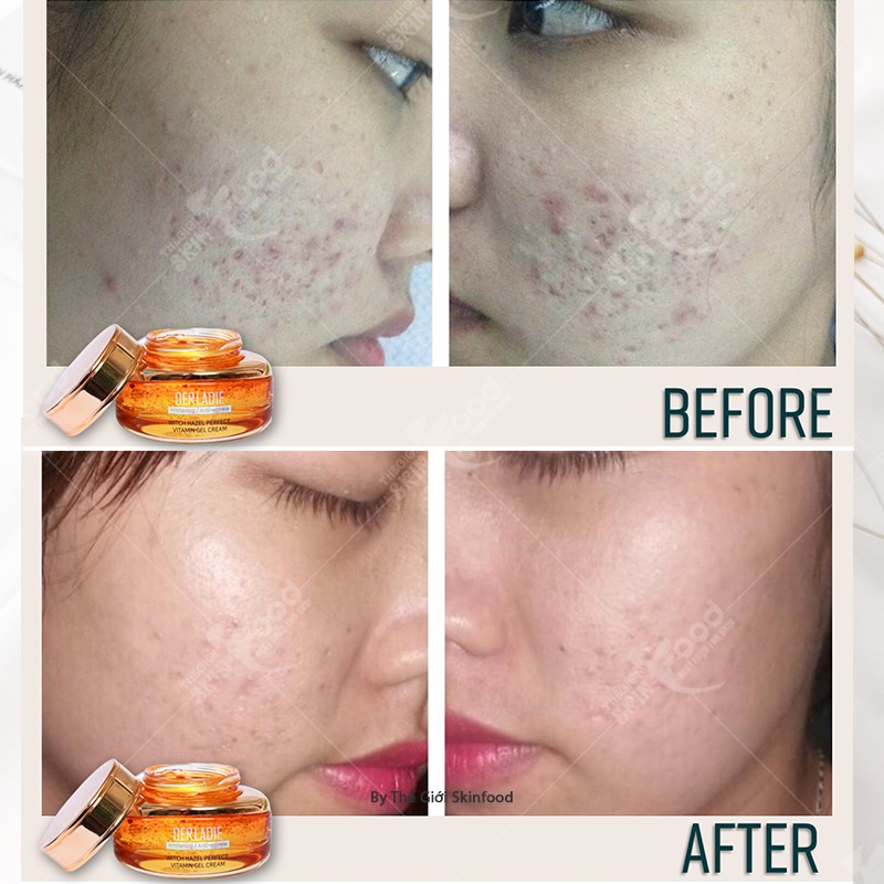 Kem Dưỡng DERLADIE Witch Hazel Perfect Vitamin Gel Cream Ngừa Mụn, Giảm Thâm, Làm Đầy Sẹo Rỗ 55ml