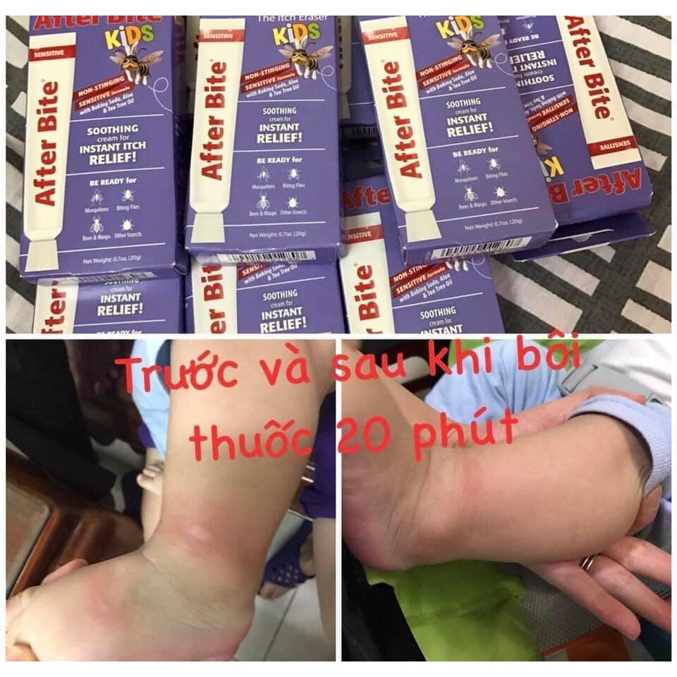 Kem bôi muỗi đốt After Bite nhập từ Mỹ
