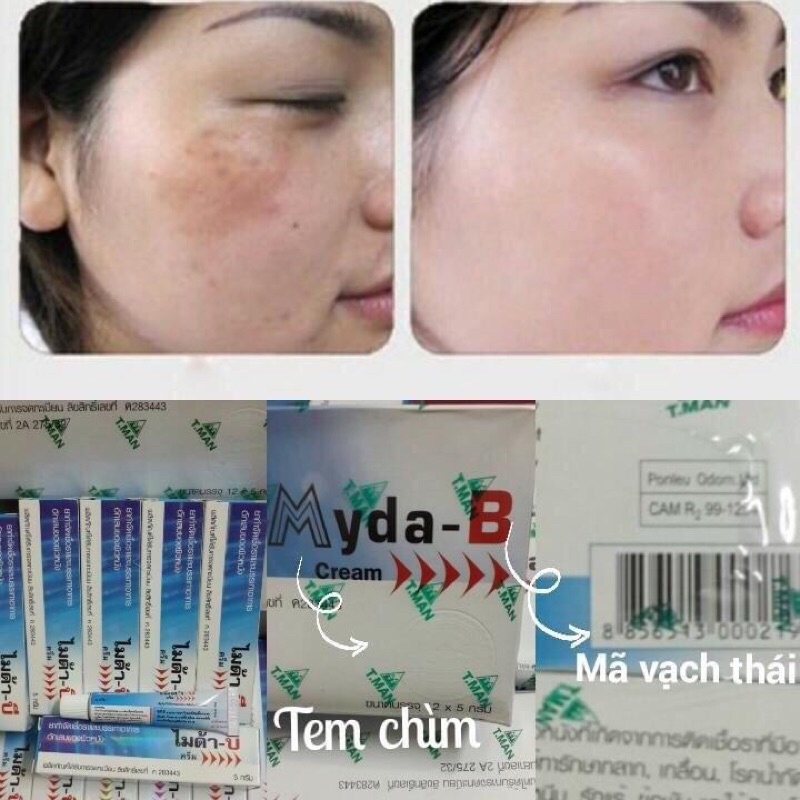 Kem đánh bay nám, tàn nhang myda-b thái lan