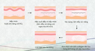 CHỈ THẨM MỸ - chỉ giảm béo