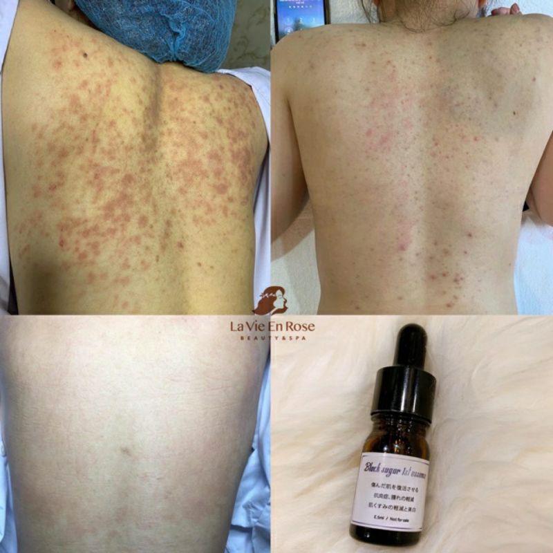 Serum đường đen Black sugar ♥️ Black sugar Nhật Bản chính hãng (PHIÊN BẢN ĐEN NGỪA MỤN TỐT HƠN) ko vỏ hộp | BigBuy360 - bigbuy360.vn