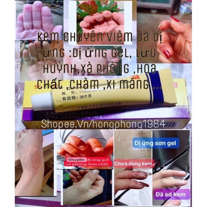 Kem bôi ngoài da dị ứng Sơn gel ,lưu huynh làm móng ,Nail,hc làm tóc ,mực xăm ,xà phòng ,chàm ,nam móng ,mụn nước …