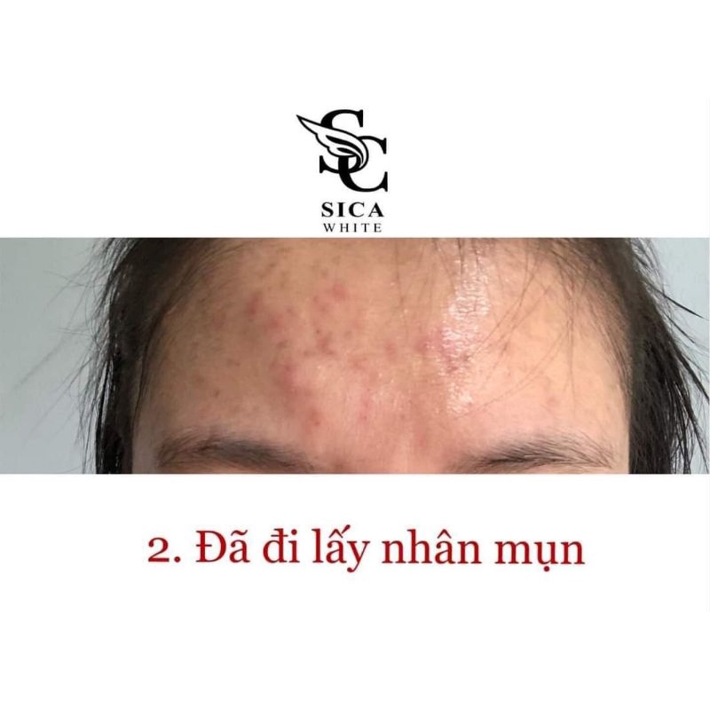 Face Mụn Sica | BigBuy360 - bigbuy360.vn