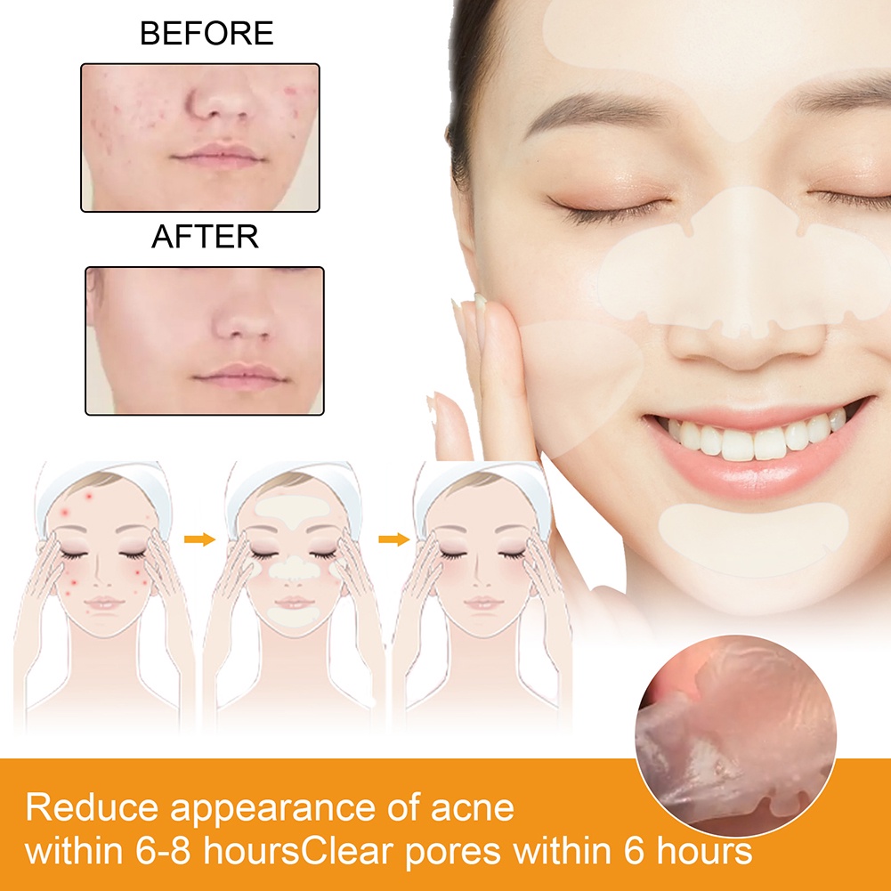 EELHOE Mụn Vá Hydrogel Mặt Mụn Mụn Vá Hydrocolloid Gel Da TAG Điều Trị Loại Bỏ Dán Chăm Sóc Da Mặt Cầm Tay Trong Suốt Vô Hình vá Nhanh giao hàng