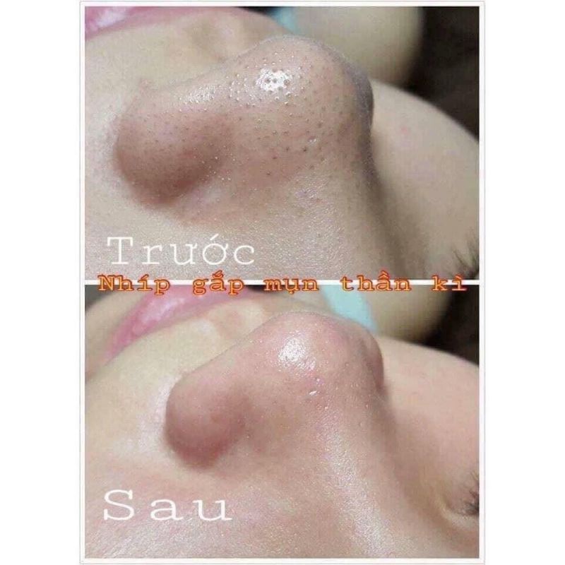 Nhíp lấy mụn đầu đen, Nhíp gắp mụn thần thánh