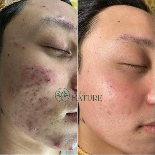COMBO  MỤN DOCTOR NATURE