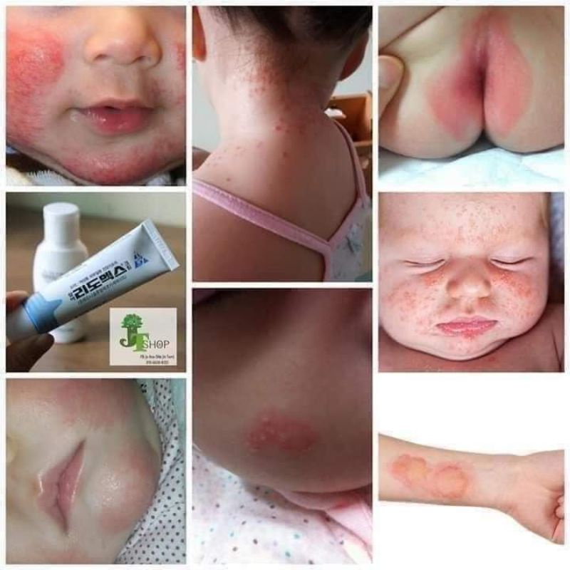 Kem Bôi Ngoài Da Lidomex giảm hăm ,ngứa ,mụn 15g Hàn Quốc