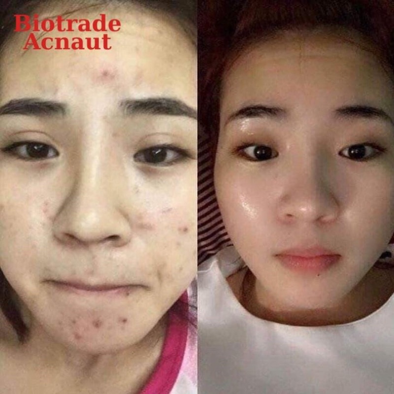 Lotion giảm mụn 10ml/ kem chấm mụn Biotrade Acne Out Active Lotion 5ml