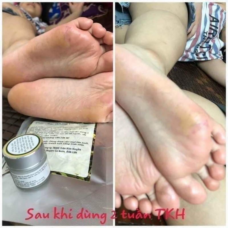 KEM BÔI DA TRẦN KIM HUYỀN