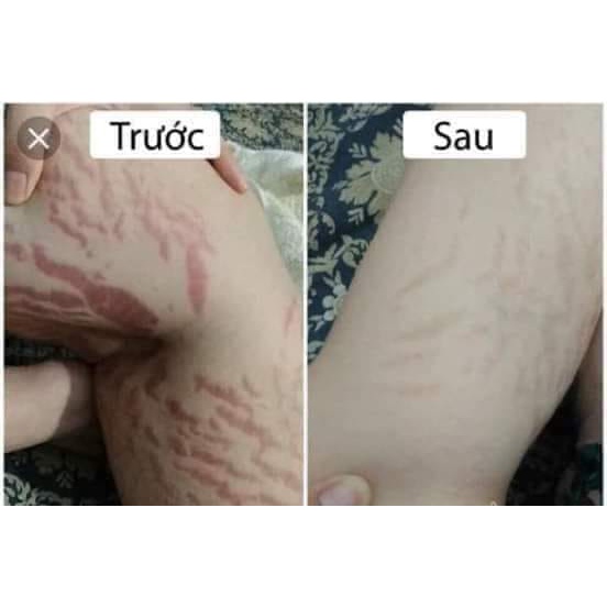 "GIÁ SỐC" Kem sẹo rỗ, sẹo thâm, sẹo rạn , sẹo thủy đậu
