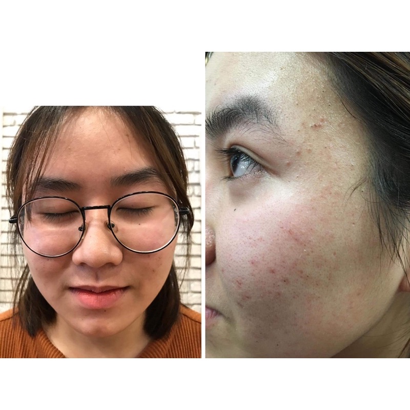 Serum mụn Nhà Bơ