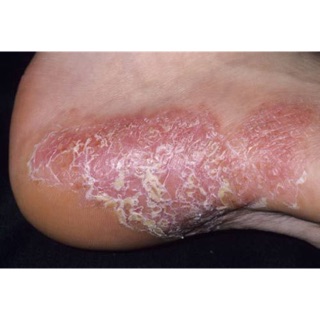 Thuốc bôi trị á sừng của Đức Glysolid