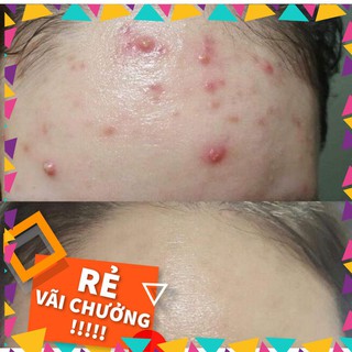 TINH CHẤT SERUM TAVIDA DÀNH CHO DA MỤN