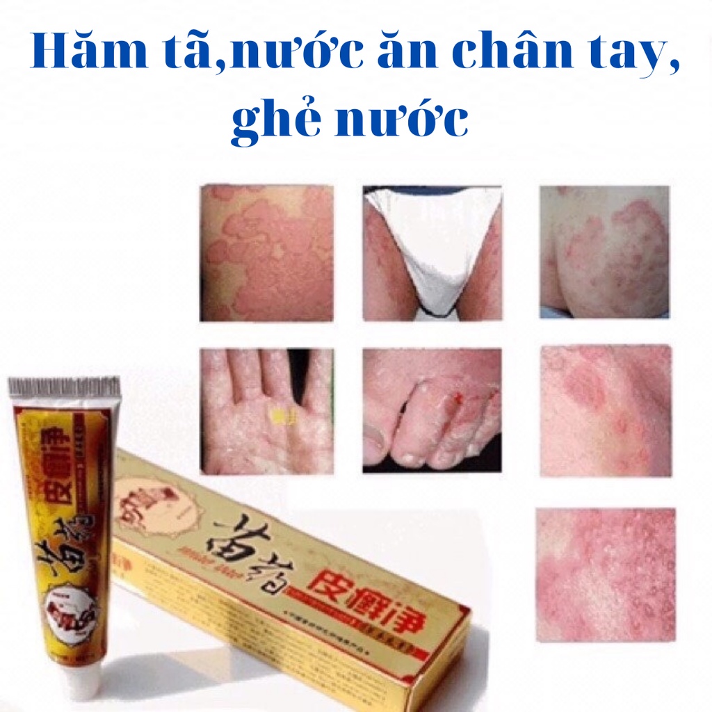 Kem bôi vảy nến nấm bẹn mông - Kem bôi nấm ngứa nước ăn chân tay