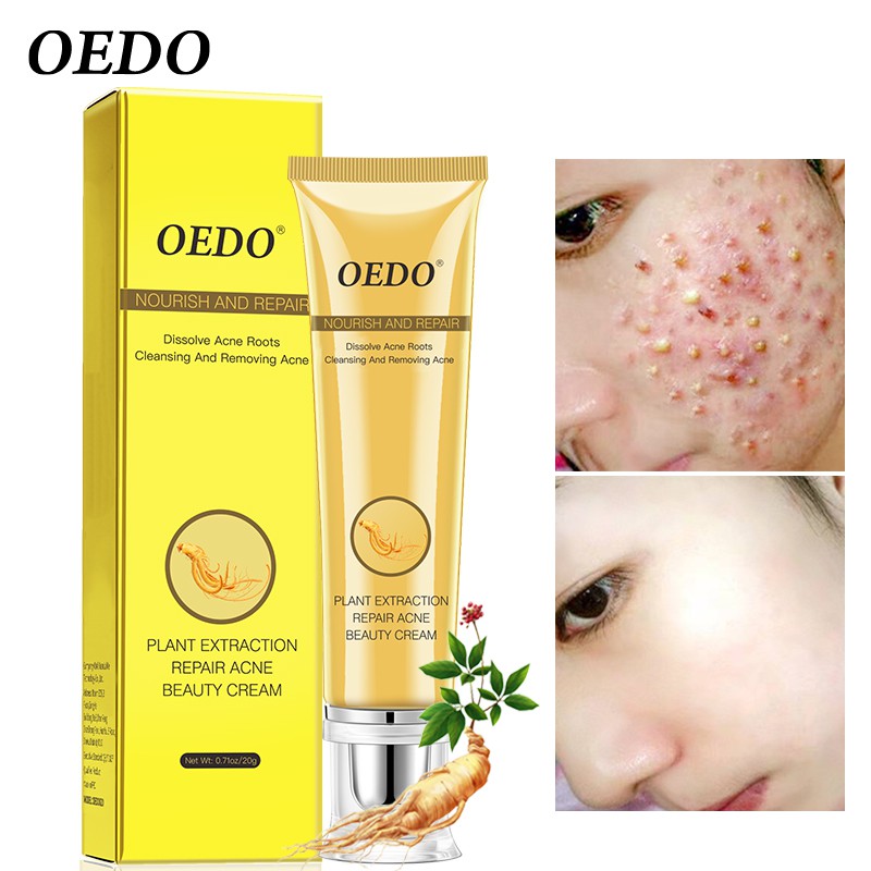 Kem Hỗ Trợ Giảm Mụn OEDO Kiềm Dầu Thu Nhỏ Lỗ Chân Lông Ngăn Ngừa Mụn 20g | BigBuy360 - bigbuy360.vn